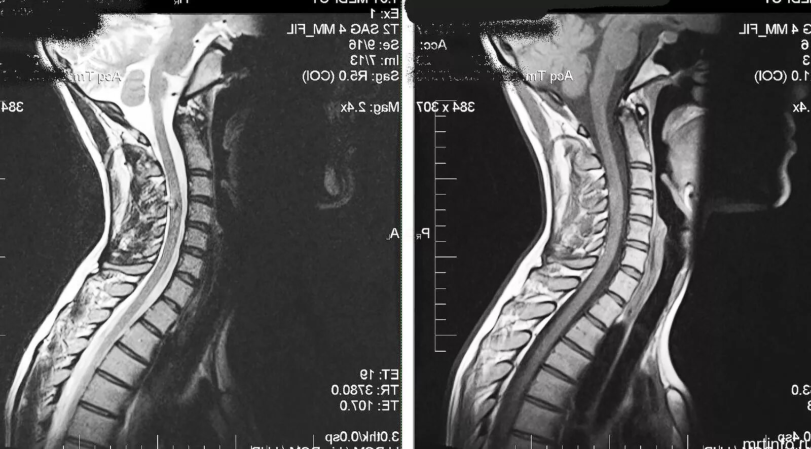 Мрт шейного отдела позвоночника по времени. Снимок мрт норма шейный отдел. Мрт шейного отдела позвоночника норма. Мрт шейного отдела позвоночника остеохондроз. Мрт позвонков шейного отдела.