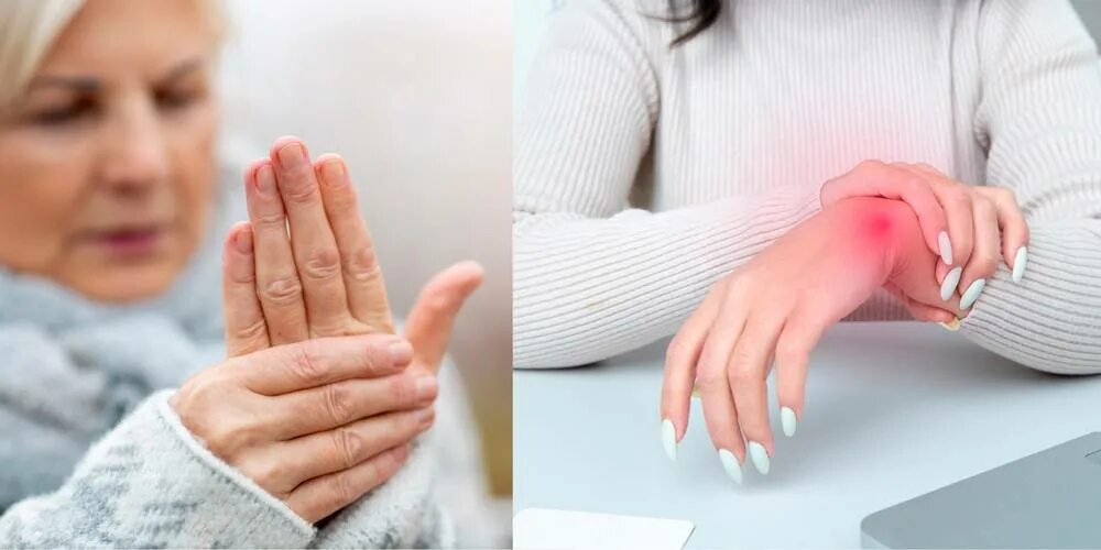 Болят большие пальцы рук лечение. Болят суставы кистей рук. Ревматоидный артрит кистей рук. Ревматоидный артрит кистей пальцев рук.