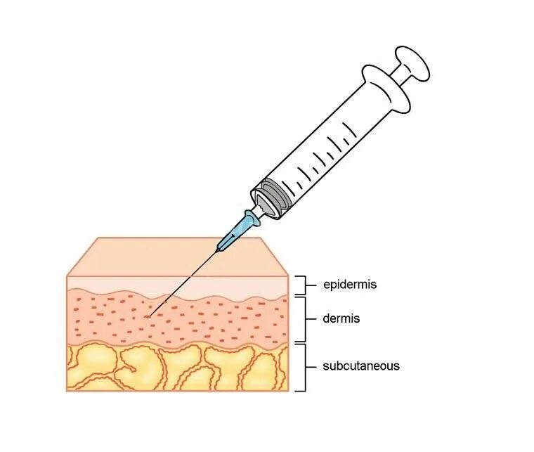 Внутрикожная игла длина. Схема глубины инъекций мезотерапии.. Схема укола мезотерапия. Техника папул в мезотерапии. Глубина введения инъекций.