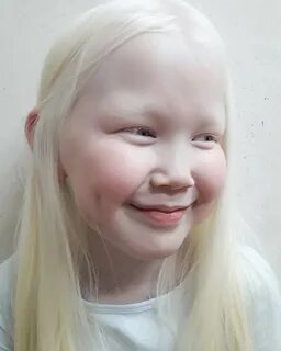 Albinose