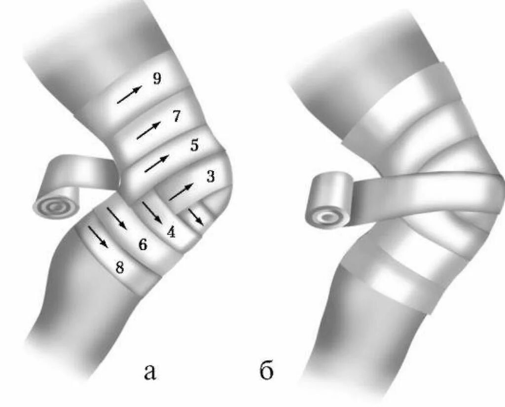 Бинтование колена эластичным бинтом. Черепашья повязка на локтевой и коленный сустав. Бинтование колена эластичным бинтом при травме. Перевязка колена эластичным бинтом. Как перевязывать колено