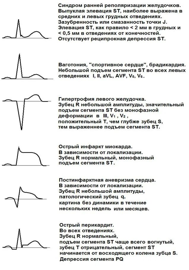 Элевация ст на ЭКГ. Инфаркт ЭКГ элевация St. Ишемическая элевация сегмента St норма. Элевация и депрессия St на ЭКГ. Нарушение реполяризации передне перегородочной области