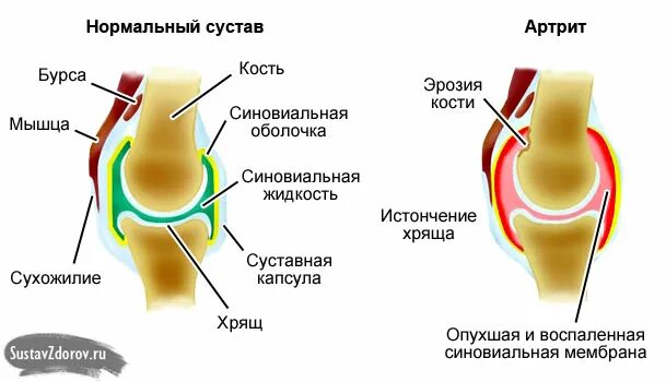 Артрит капсулы. Разрыв суставной капсулы пальца. Синовиальная сумка сустава.