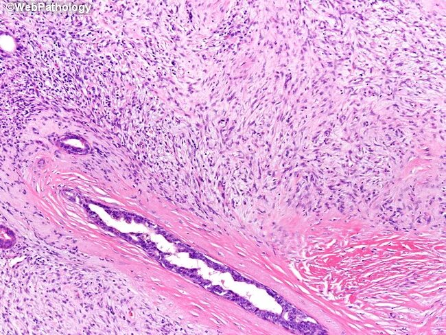 Verrucous carcinoma of larynx