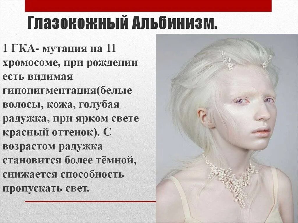 Человек с самой светлой. Глазокожный альбинизм 1 ГКА. Альбинизм генная мутация. Генные болезни альбинизм.
