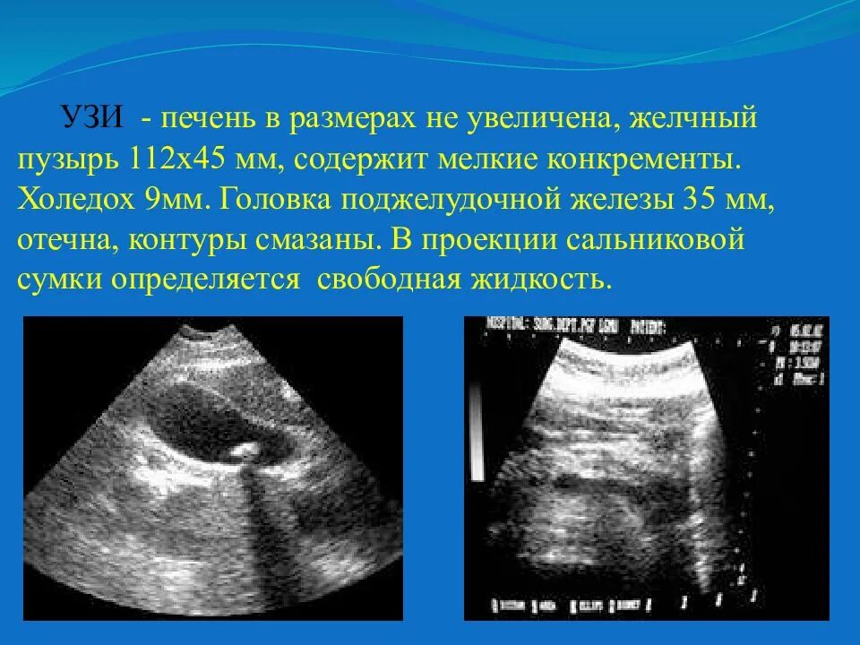 Показатели узи печени. Диаметр холедоха УЗИ. УЗИ желчного пузыря нормы содержимое. Стенки желчного пузыря на УЗИ. Ультразвуковое исследование печени.