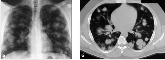 Метастазы в легких лимфоузлы. Метастазы в легких рентгенограмма. Метастазы в легком рентгенограмма. Канцероматоз лёгких кт.