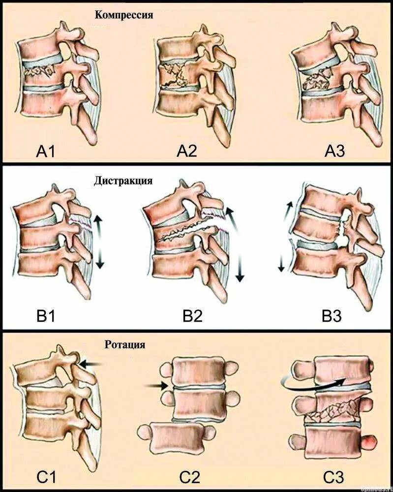 Классификация переломов позвоночника по Magerl. Компрессионный перелом позвоночника поясничного отдела. Дистракционный перелом позвоночника. Патогенез компрессионного перелома позвоночника.