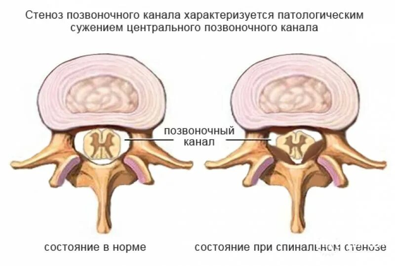 Дегенеративный спинальный стеноз l3-l4. Вертеброгенная люмбалгия. Сужающийся восходящий канал. Воспаление слезно носового канала. Позвоночный канал диаметр.