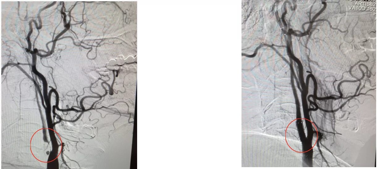 Стентирование сосудов сонной артерии. Эмболизация аневризмы. Стеноз внутренней сонной артерии стентирование. Операция на артерии шеи