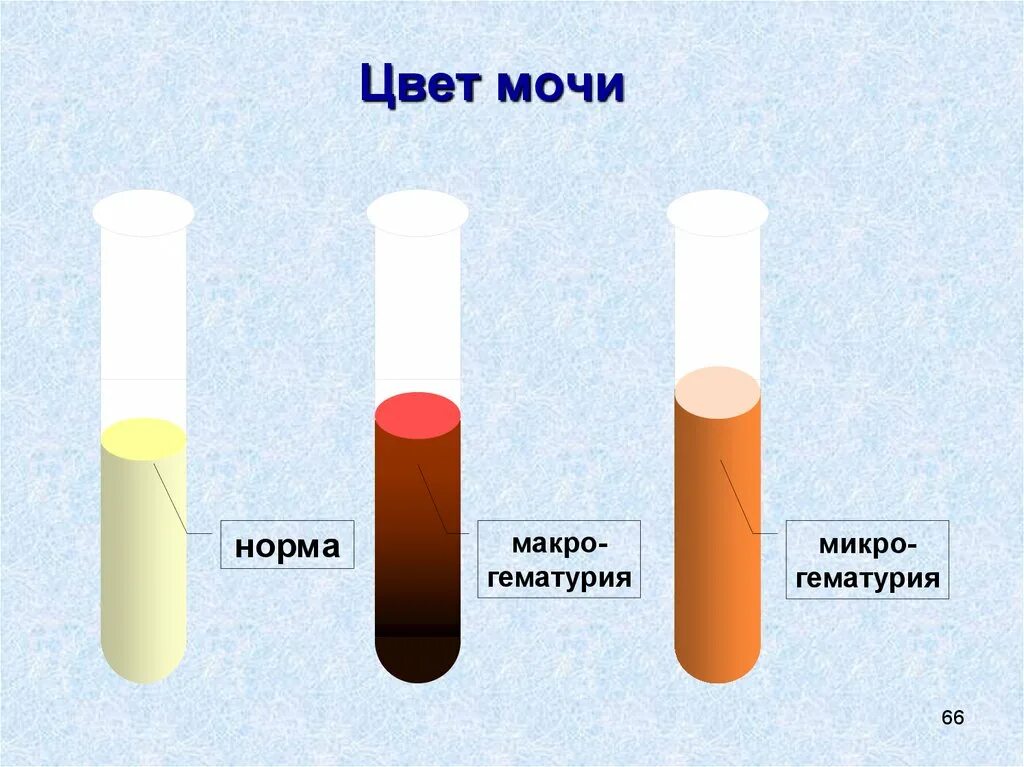 Моча кровь что пить. Гематурия цвет мочи. Микрогематурия цвет мочи.