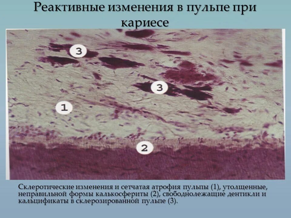 Часть клеток с реактивными изменениями. Сетчатая атрофия пульпы. Патологическая анатомия пульпа.