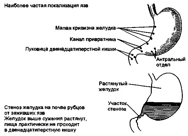 Язвенная болезнь желудка локализация. Язва малой кривизны тела желудка схема. Язва малой кривизны желудка. Язвенная болезнь малой кривизны желудка. Размеры язвы желудка