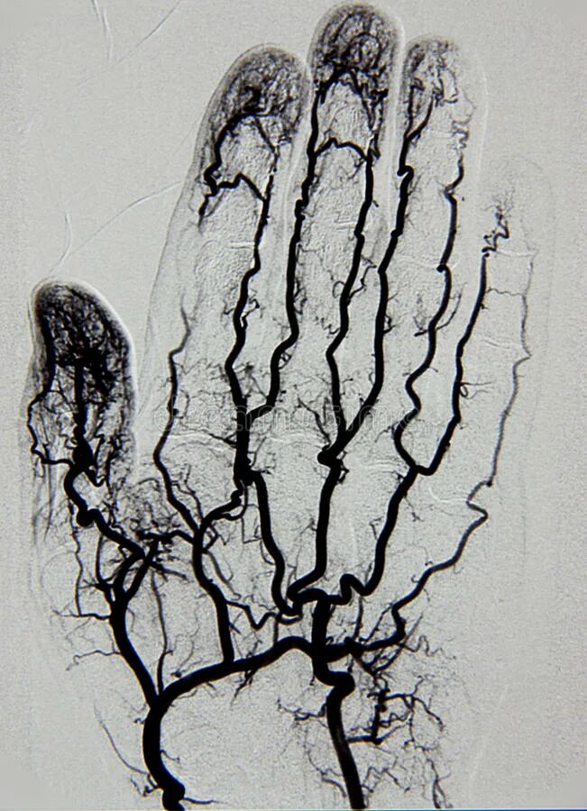 Контраст артерии. Кт церебральная ангиография сосудов головного мозга. Коронарография сосудов сердца. Селективная церебральная ангиография что это. Ангиография артерий головного мозга.
