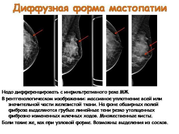 Как лечить фиброзные изменения