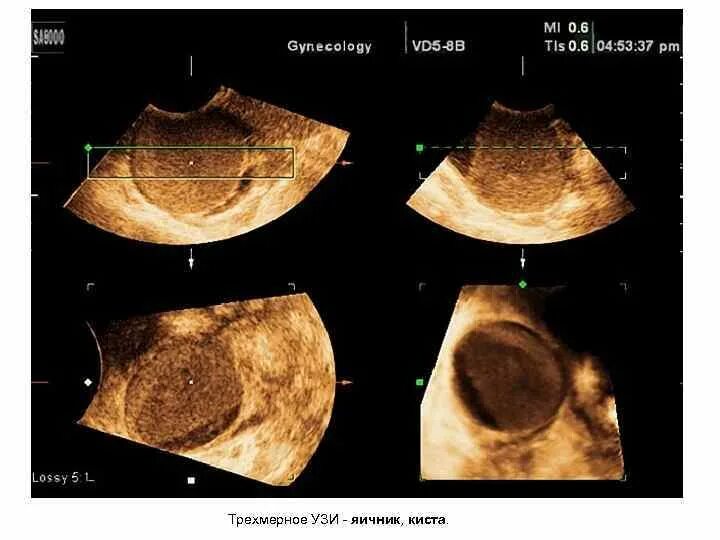 Климакс на узи. Тератодермоид яичника. Дермоидная киста яичника на УЗИ.
