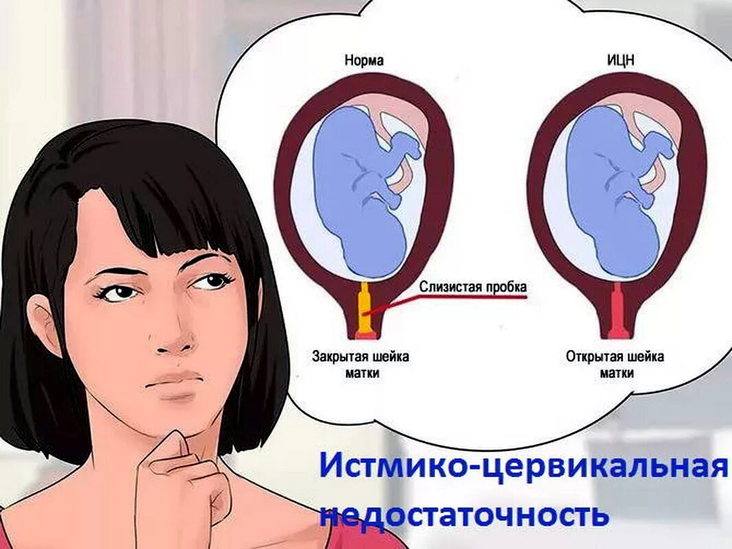 Истмико-цервикальная недостаточность. Иствикоцервикальрая недостаточность. Истомоеоцервикальнач недостаточность. Зев закрыт при беременности