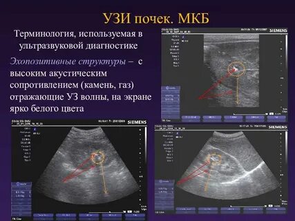 Мкб почек