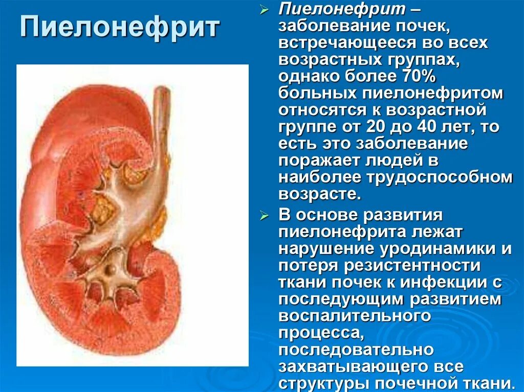 Пелонифри. Заболевание почек пиелонефрит. Воспаление почек пиелонефрит.