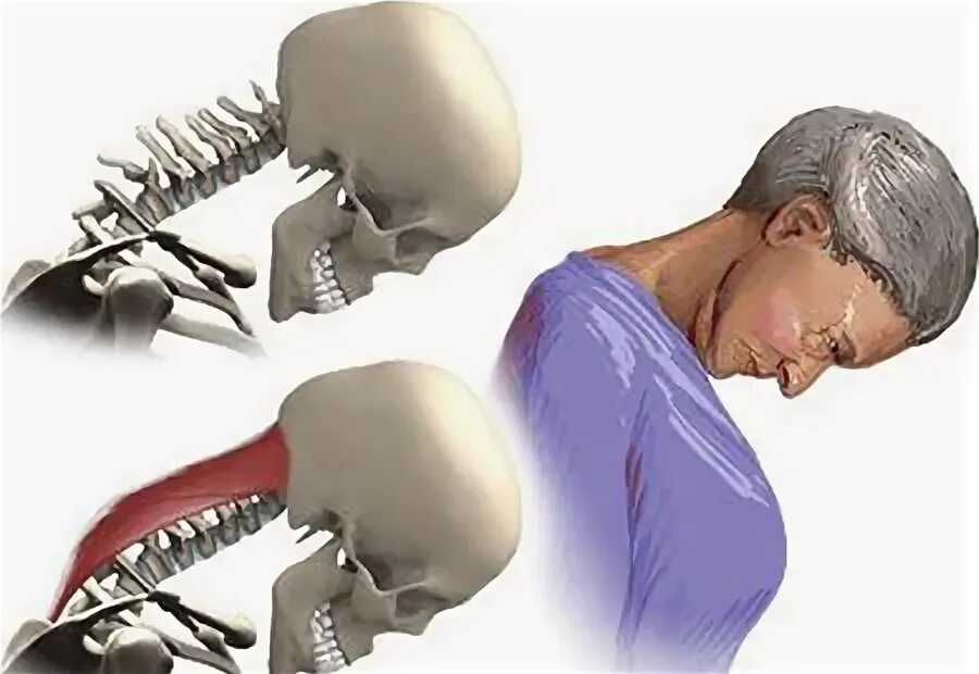 Head drop