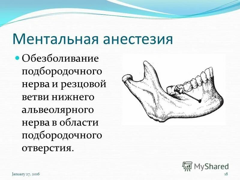 Проводниковая анестезия нижней челюсти мандибулярная. Мандибулярная анестезия нижней челюсти. Мандибулярнаанестезия на нижней челюсти. Торусальная анестезия методика.