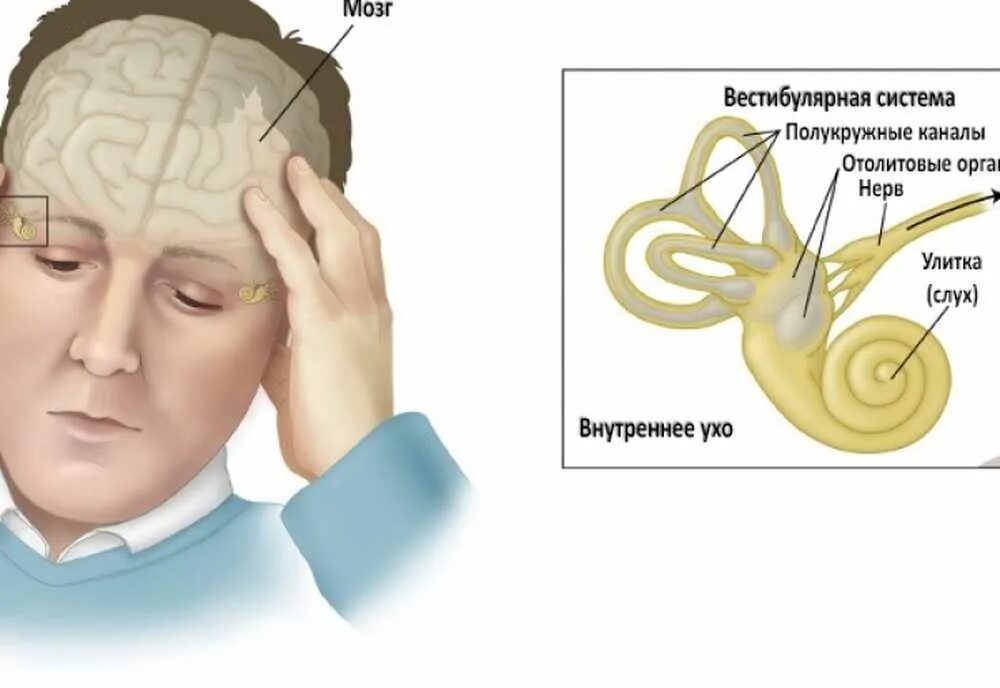 Нарушения вестибулярного аппарата головокружение. Вестибулярный аппарат нарушения. Нарушение вестибулярного аппарата симптомы. Нарушение вестибулярного аппа. Дисфункция вестибулярного аппарата.