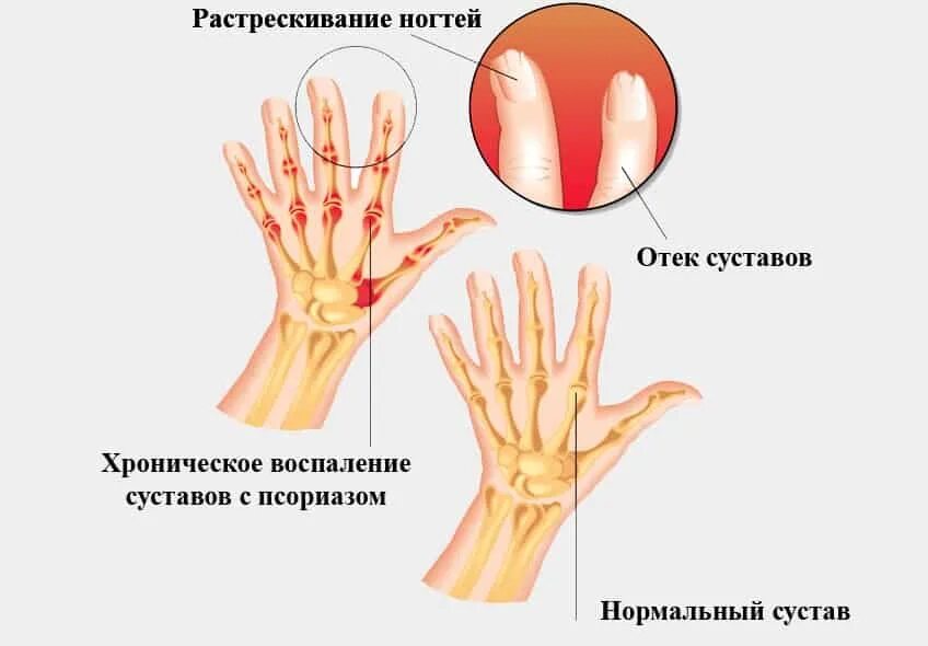 Артрит рук народное лечение. Псориатический артрит голеностопного сустава. Псориатический артрит клинические симптомы. DAPSA псориатический артрит. Псориатрический ревматоидный артрит.