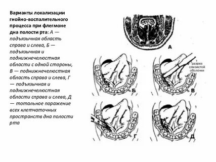 Флегмону дна полости