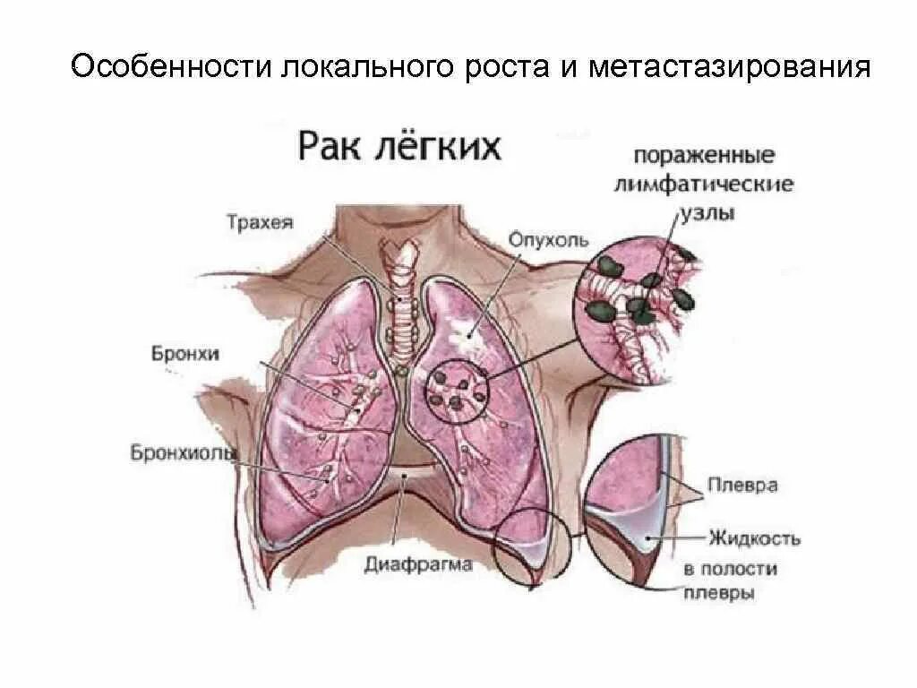 Стадии рака бронха