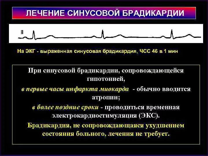 Лекарства при брадикардии. Лекарства при брадикардии