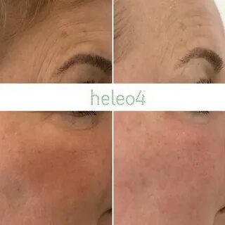 Heleo4 отзывы о процедуре