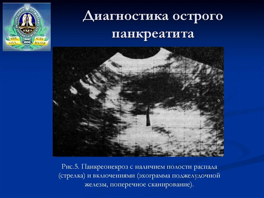 Инструментальная диагностика острого панкреатита. Инструментальные методы при остром панкреатите. Исследования при остром панкреатите. Острый панкреатит физикальное обследование. Острый панкреатит врач