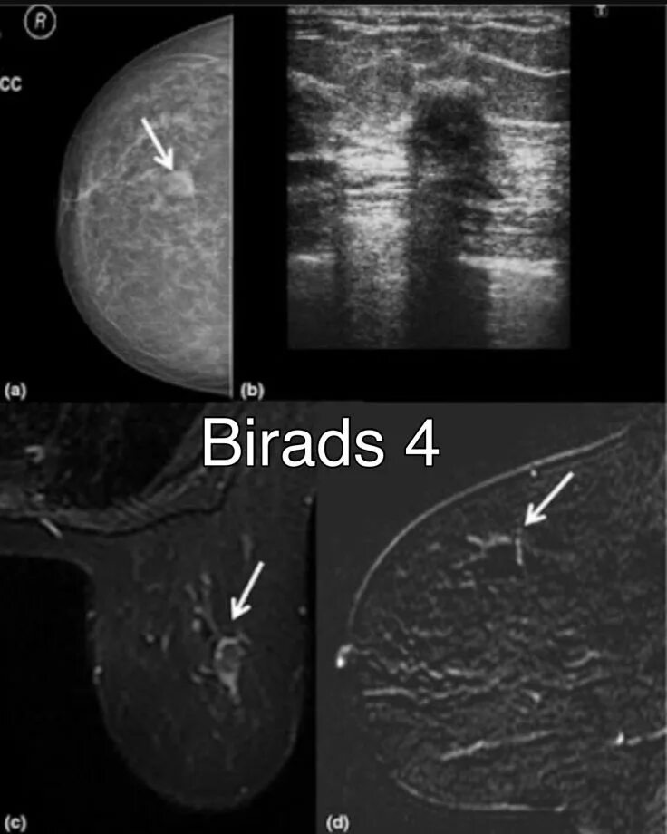 Диагноз birads:4a. ММГ bi-rads 4a. Bi rads 4 молочной железы. Birads 1 молочной железы что это такое.