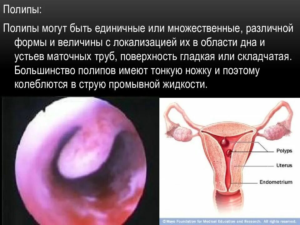 Диагноз полип матки. Гистероскопия полипа матки. полип в устье маточной трубы. полип эндометрия в матке.