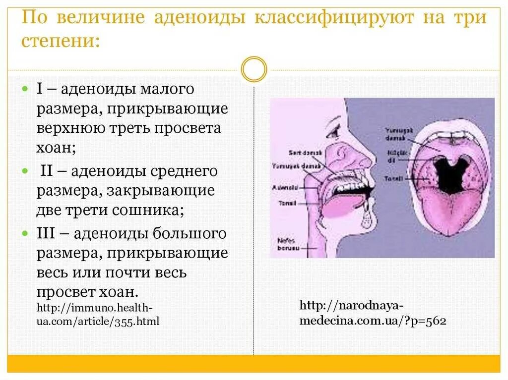 Аденоиды 2 степени у ребенка 4 года. Увеличением объема лимфоидной ткани (аденоиды),. гипертрофия глоточной миндалины аденоиды. гипертрофия аденоиды 2 степени. аденоиды гипертрофия 3 степени.