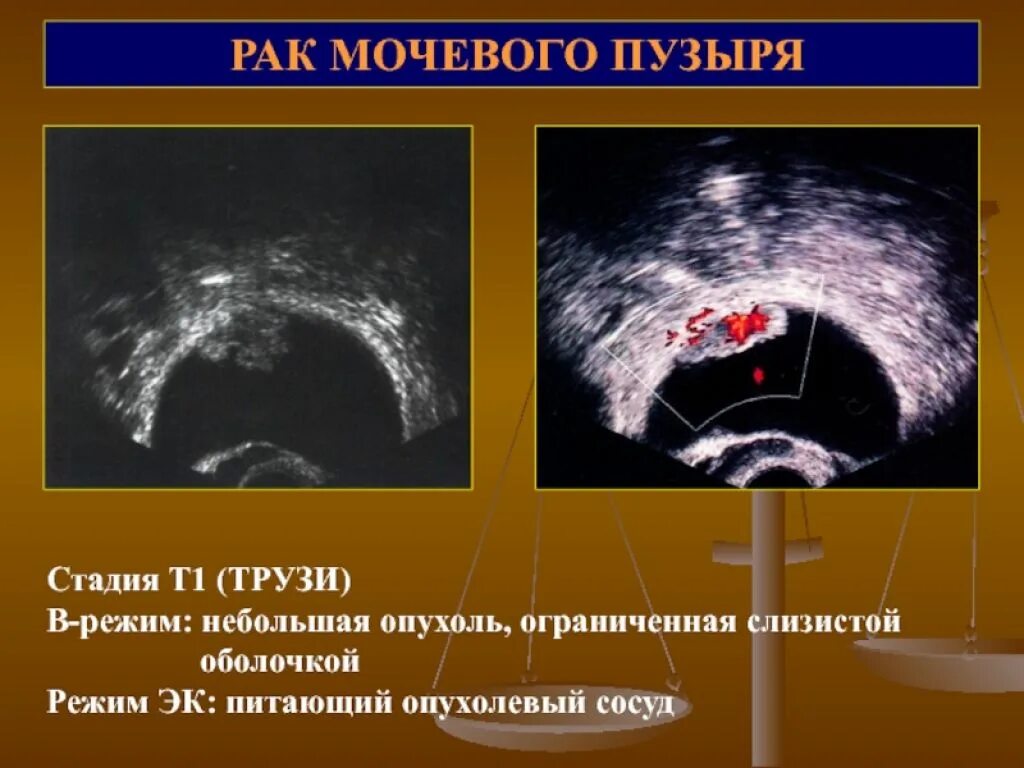 Удаление мочевого пузыря при раке. Опухоль мочевого пузыря. Раковая опухоль мочевого пузыря. Опухоли мочевогоп пузыря. Злокачественные новообразования мочевого пузыря.