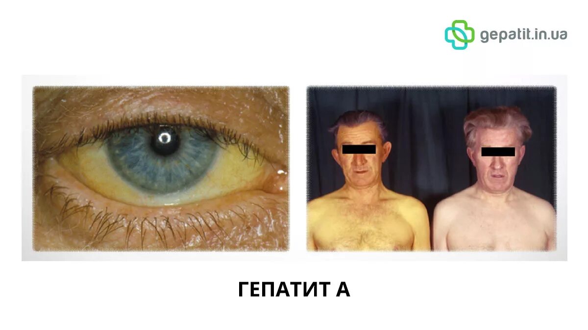 можно ли заболеть желтухой