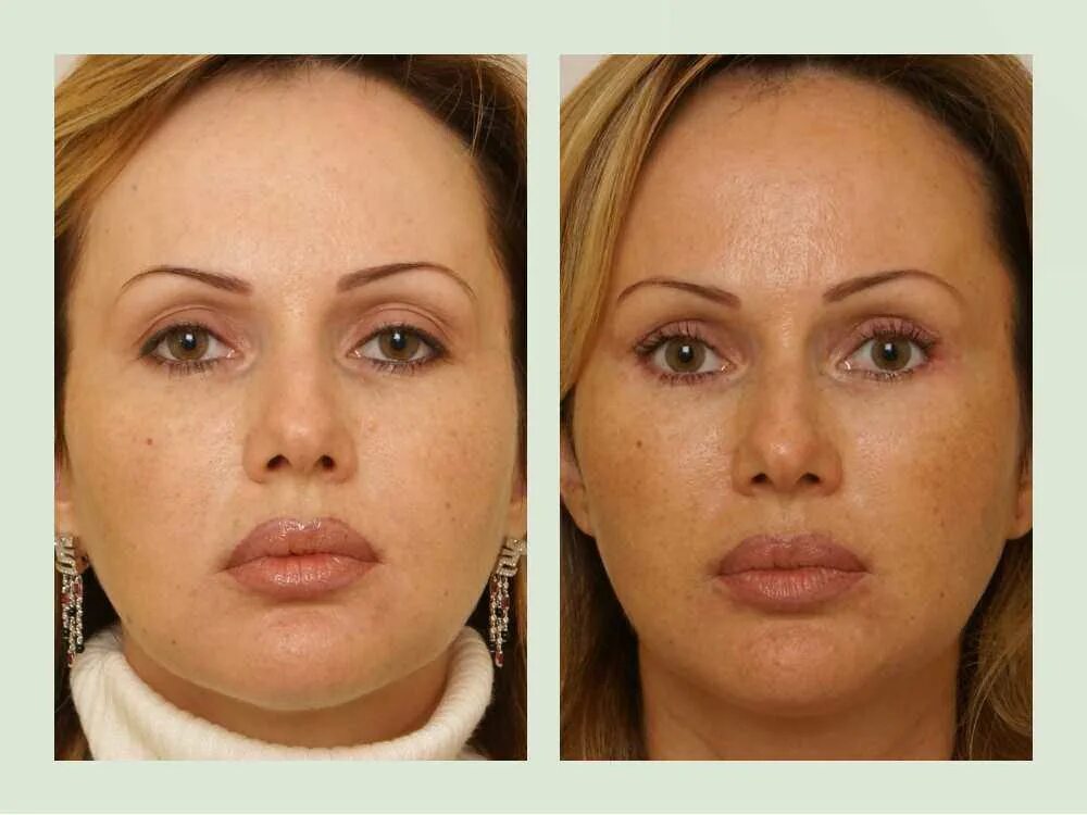 платизмопластика платизмопластика.