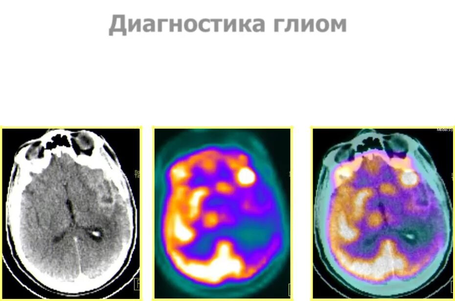 ПЭТ кт с метионином глиома. ПЭТ кт с метионином лучевой некроз. ПЭТ кт с метионином в картинках. Что такое глиома