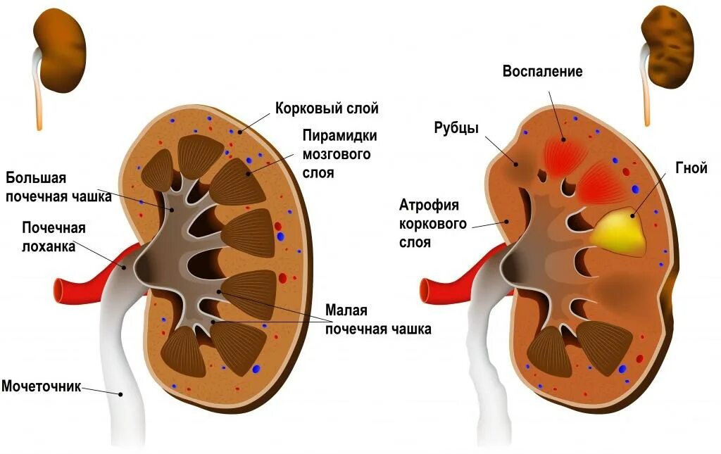 Болезнь почекпилонефрит. Болезнь почек пиелонефрит. Строение чашечно лоханочной системы почек. Патология почки. Пиелонефрит.