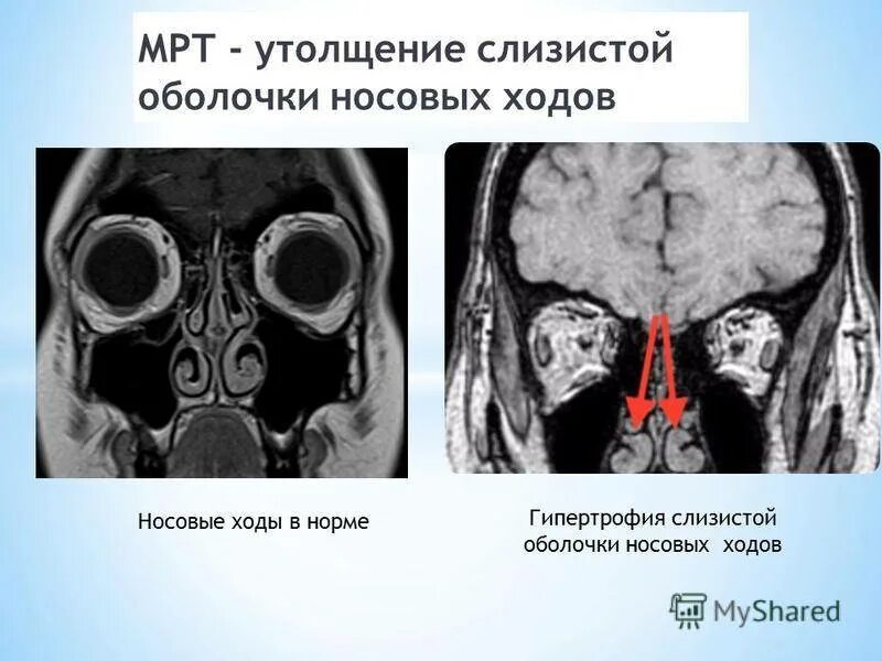 Пристеночное утолщение слизистой оболочки. Утолщение слизистой оболочки верхнечелюстных пазух кт. Утолщение слизистой верхнечелюстной пазухи на кт. Кт гипертрофия гайморовой пазухи. Кт гипертрофия слизистой верхнечелюстных пазух.