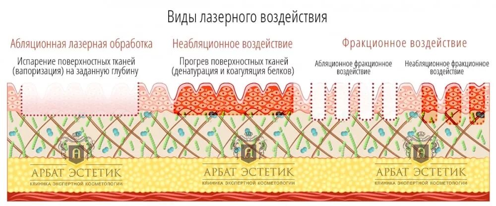 Фракционный лазерный фототермолиз кожи. Лазерная шлифовка схема воздействия. Воздействие лазера на кожу. Неабляционное лазерное омоложение.