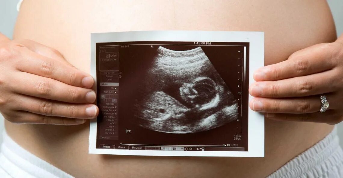 УЗИ скрининг беременных. Снимок ребенка на УЗИ.