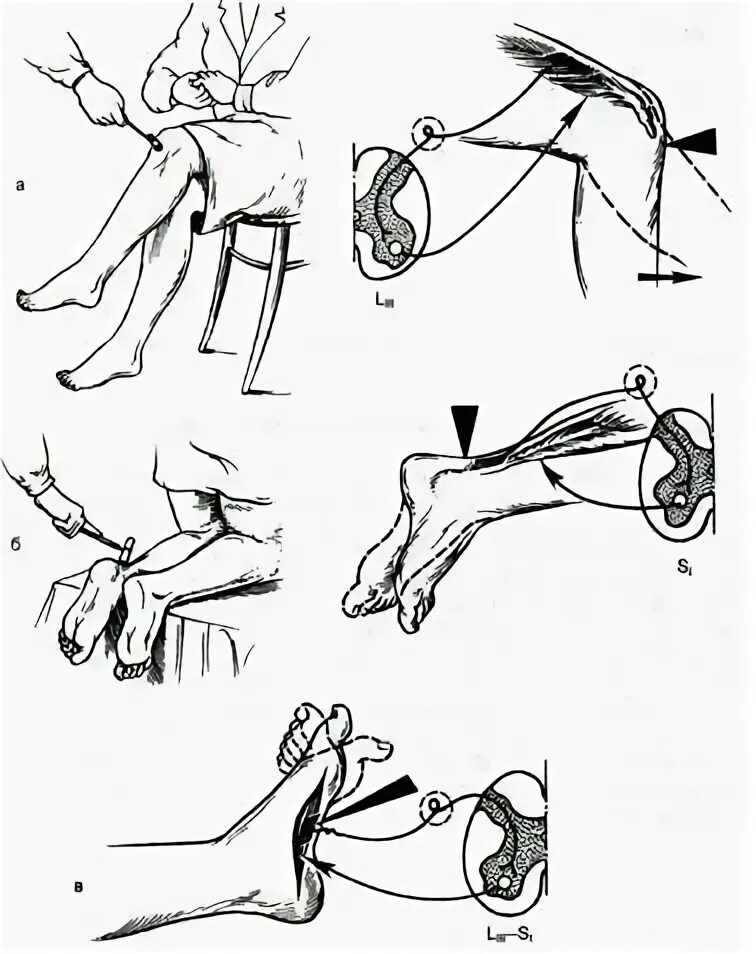 Локтевой сухожильный рефлекс. Ахиллов рефлекс. Исследовать сухожильные рефлексы верхних конечностей. Исследование сухожильных рефлексов.