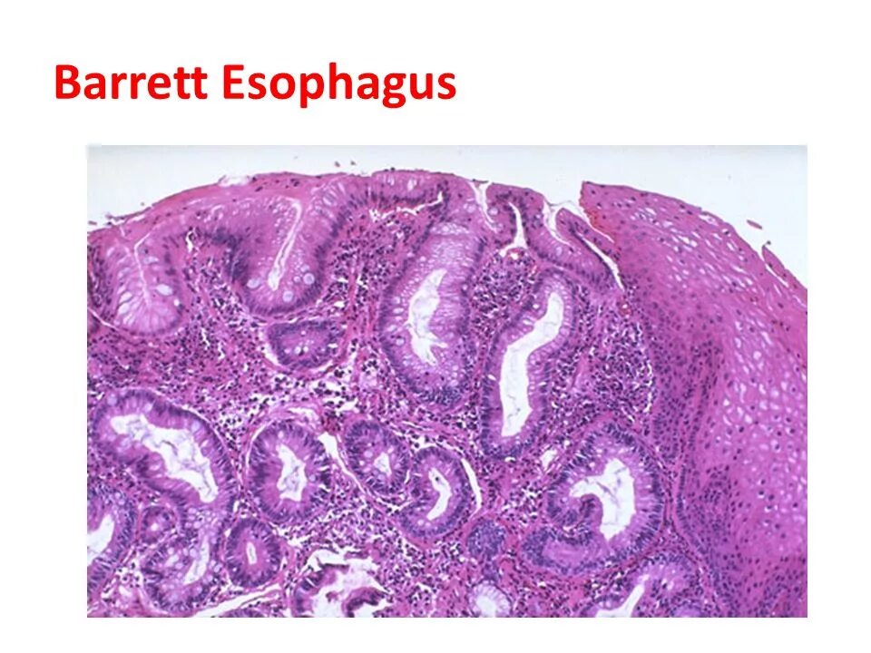 Пищевод баретта. Пищевод Барретта гистология. Пищевод Барретта микропрепарат. Кишечная метаплазия патологическая анатомия. Метаплазия желудка гистология.