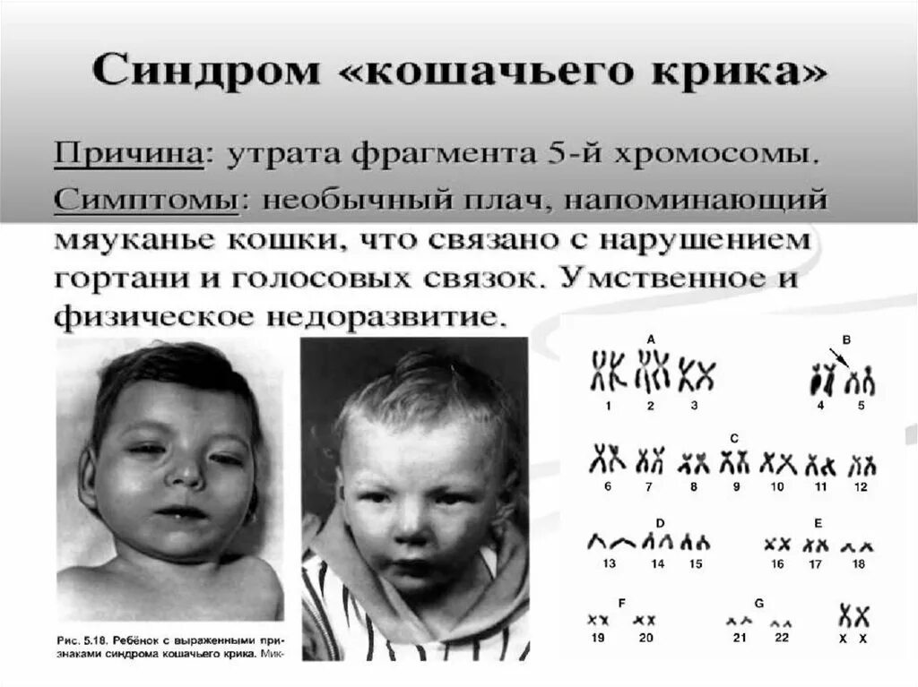 Что такое синдром крика. Синдром патау трисомия по 13 хромосоме. синдром кошачьего крика хромосомная. кариотип человека с синдромом кошачьего крика. синдром патау или трисомия по 13 хромосоме.