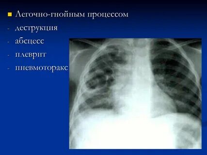 Гнойный плеврит
