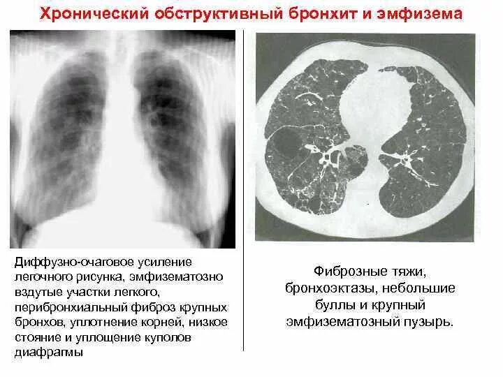 Фиброз в доле легкого. Диффузный легочный фиброз. Эмфизема легких кт. Диффузный пневмофиброз кт. Хронический обструктивный бронхит на кт.