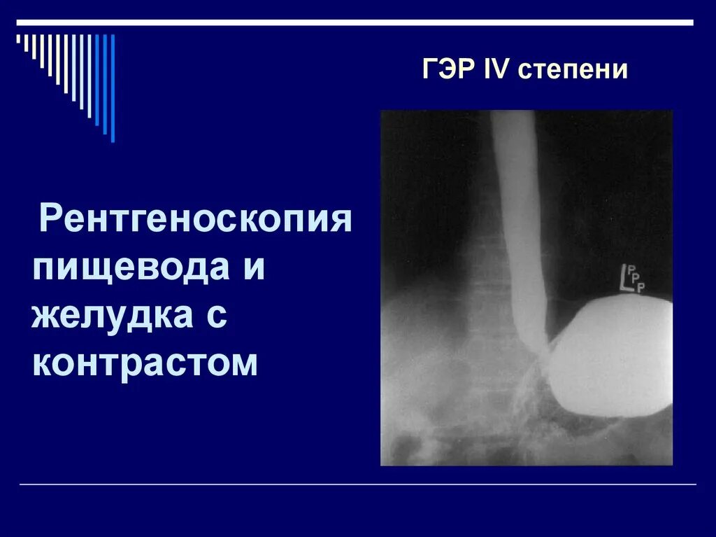 Рентгеноскопия желудка и пищевода. Контрастирование пищевода рентген. Рентген с барием пищевода и желудка. Рентгеноскопия пищевода с контрастом. Скопия пищевода желудка