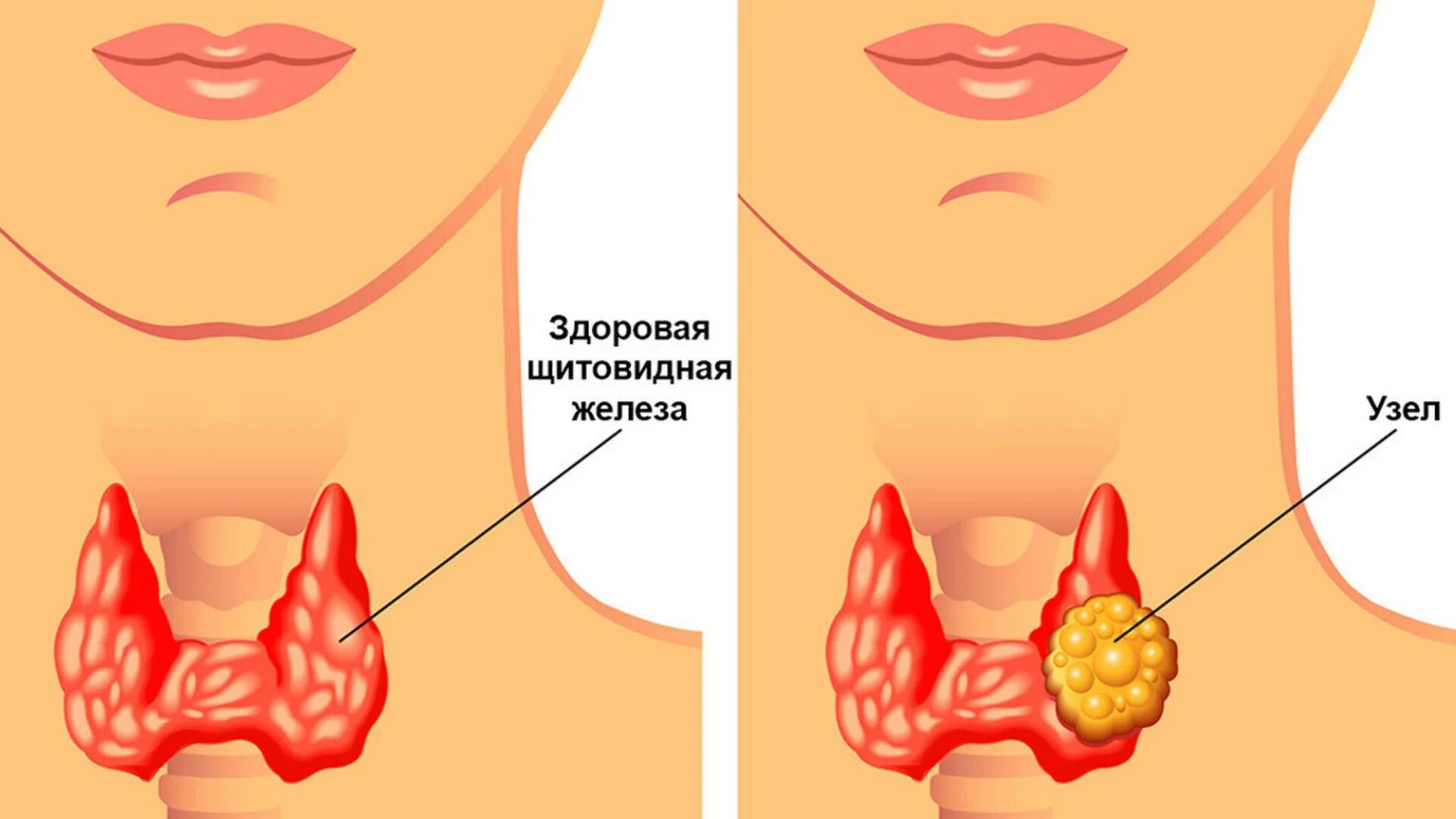 Щитовидная железа тиреомегалия. Многоузловой зоб щитовидки. Щитовидная железа зоб узлы. Тумор щитовидной железы. Многоузловой эутиреоидный зоб щитовидной железы.